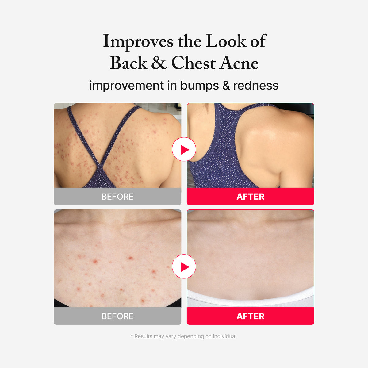 Anti Blemish Body Lotion